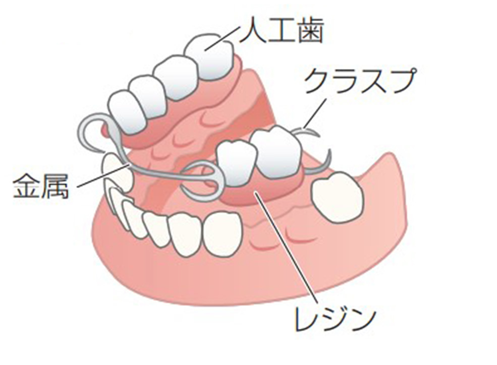 金属床入れ歯イメージ