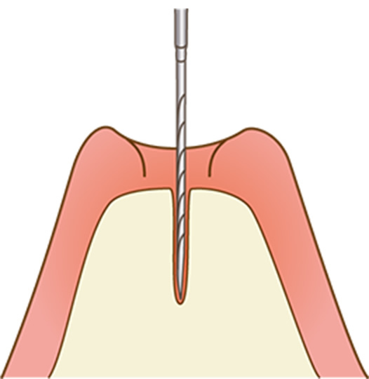 歯槽骨に穴あけイメージ