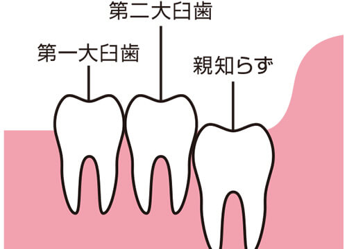 抜歯の必要性：低イメージ