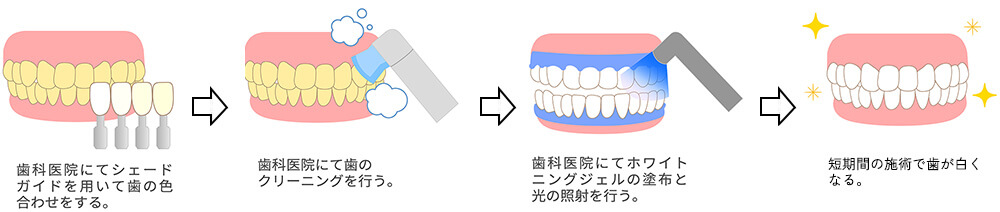 オフィスホワイトニングの流れイメージ