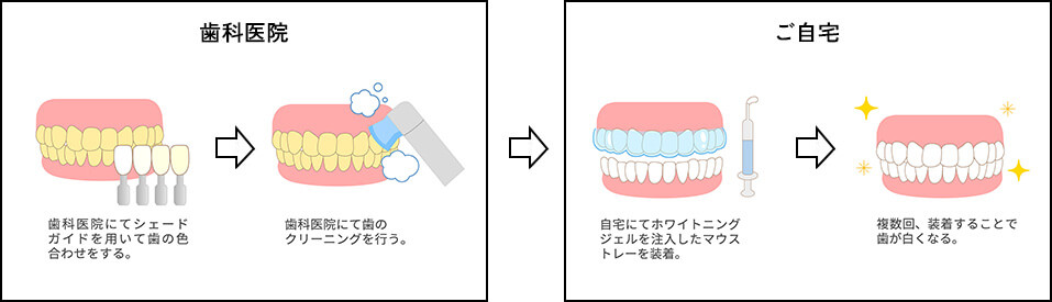 ホームホワイトニングの流れイメージ