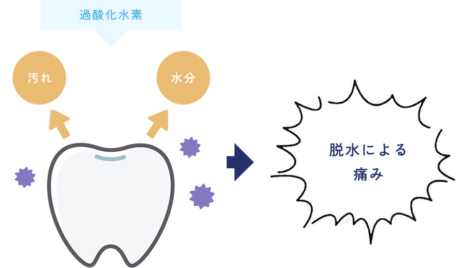 >過酸化水素を使用したホワイトニングの場合イメージ